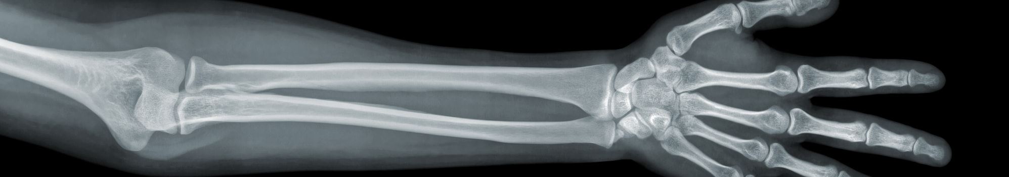 San Francisco Broken Bone Injury Lawyer | Bone Fracture Attorney